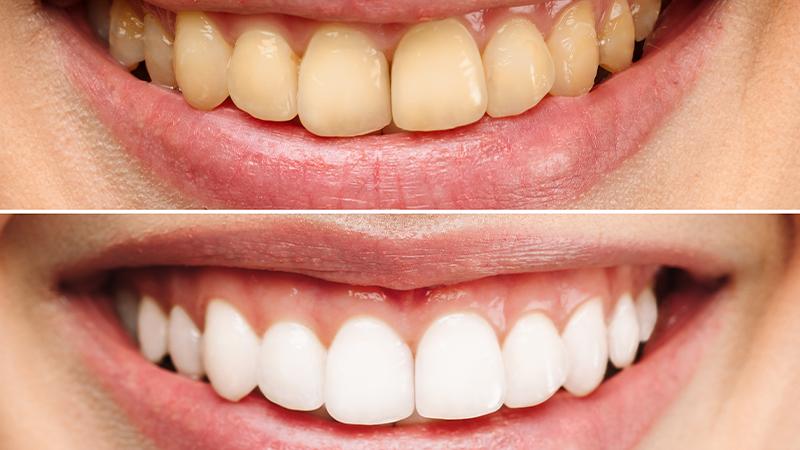Teeth Whitening & Polishing