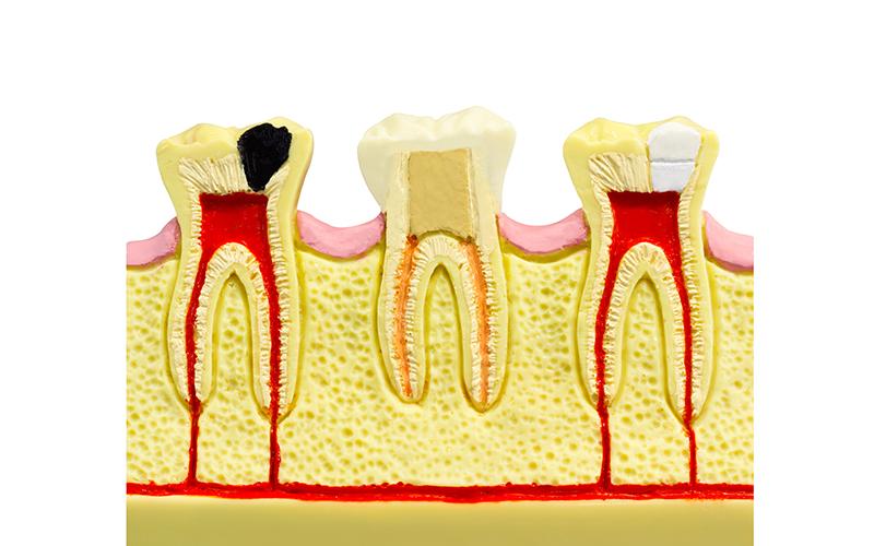 Single Sitting Root Canal Treatment (RCT)