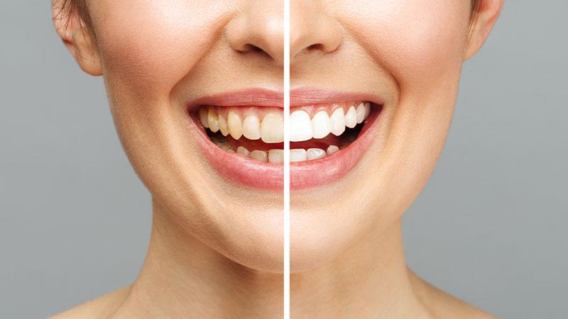 Ultrasonic Scaling and Polishing