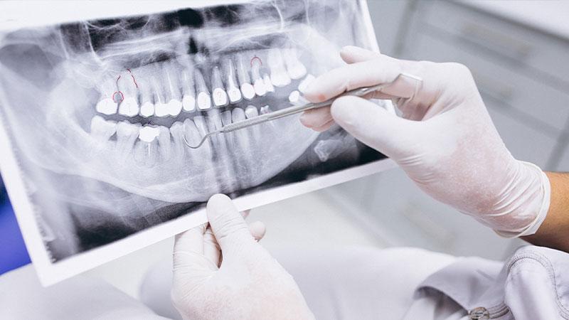 Dental X-Ray