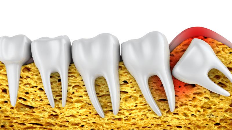 Disimpaction of Wisdom Teeth