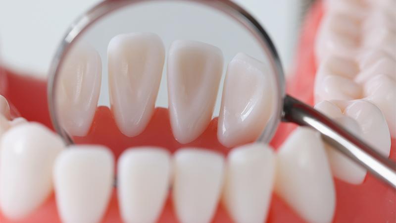 Normal Restoration / Filling of Tooth