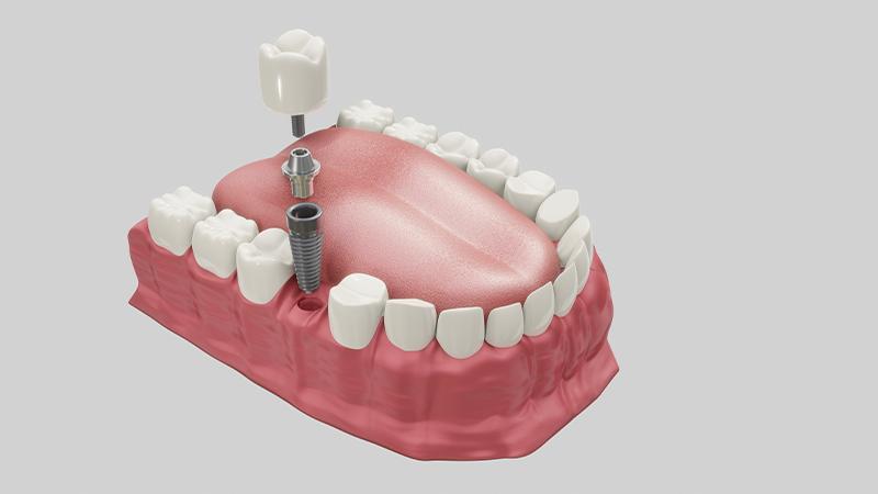 Dental Implant