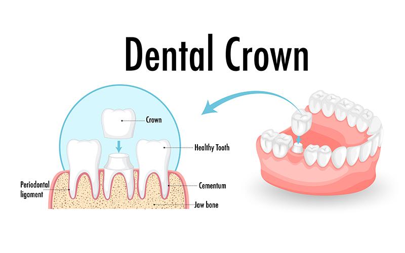Dental Crowns & Bridge