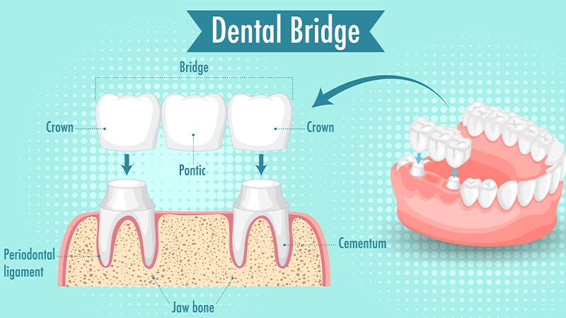 Fix Dental Crown & Bridge