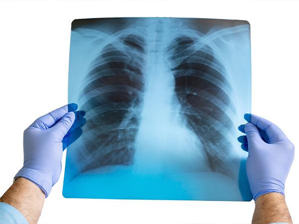 Digital X-Ray (300 MA, DR System)