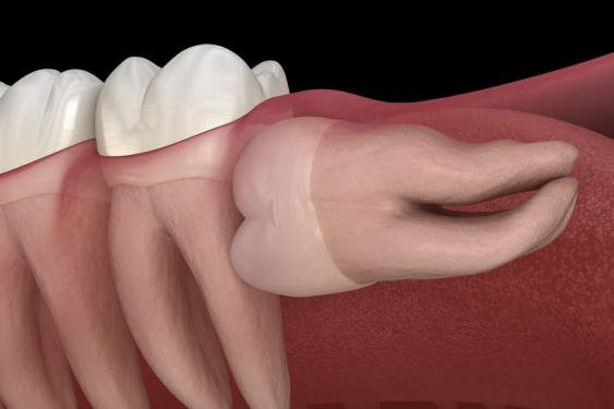 Wisdom Tooth Extraction