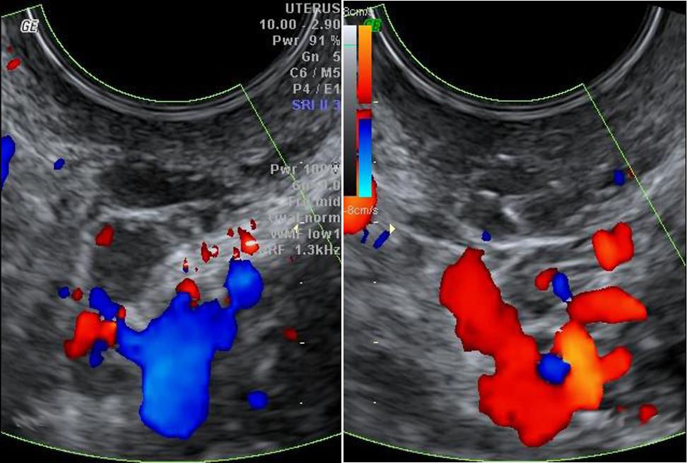 Colour with transvaginal ultrasound