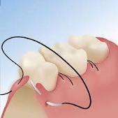 Periodontal Therapy