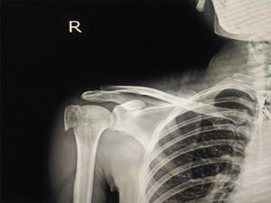 X Ray Normal Shoulder Normal Shoulder, X Ray #3 Shower Curtain By