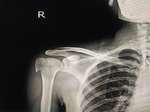 Normal Shoulder X-ray