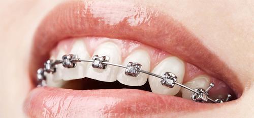 Orthodontic Treatment