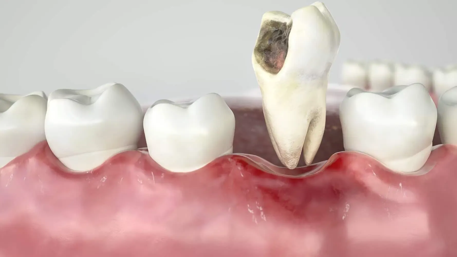 Painless Tooth Extraction