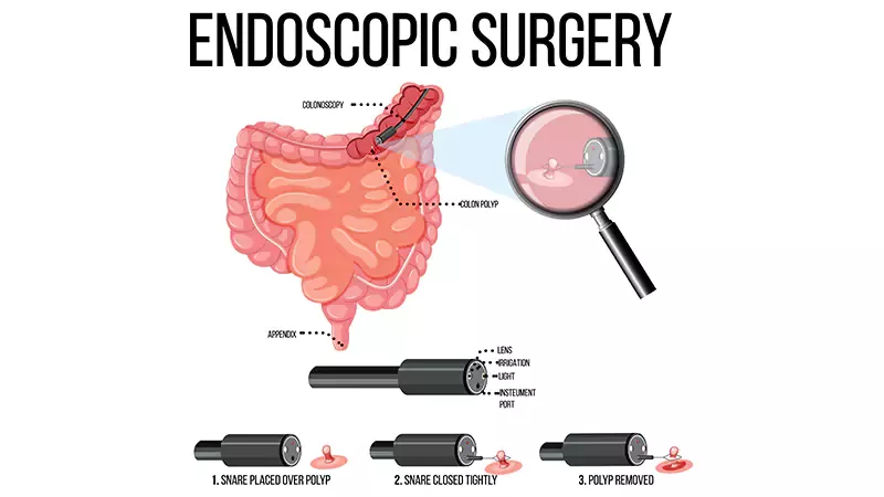 Endoscopy