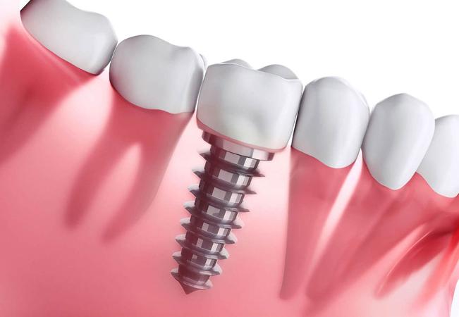 Dental Implant